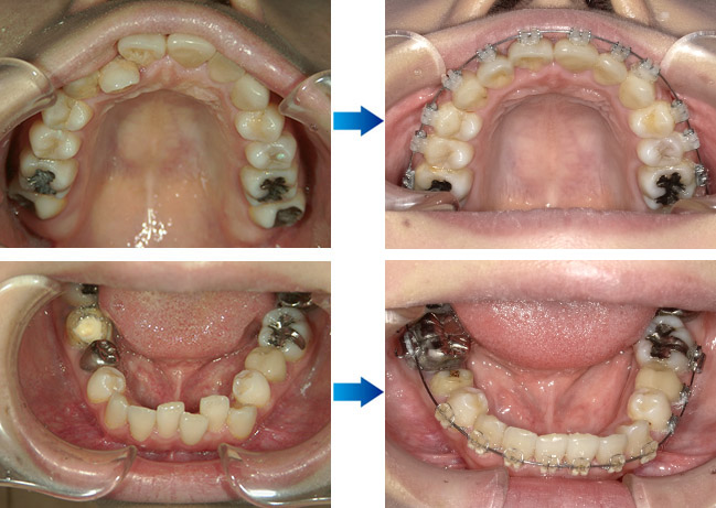 抜歯 矯正 口元 引っ込み すぎ