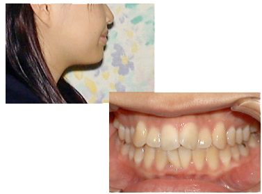 えがわ歯科矯正歯科 診療の紹介 矯正の抜歯 非抜歯