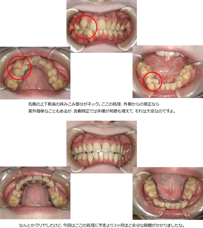 えがわ歯科矯正歯科-診療の紹介-テレスコープ義歯